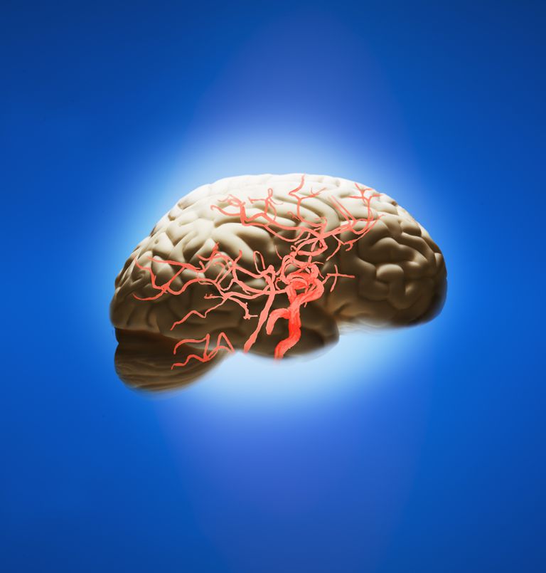 ¿Qué vasos sanguíneos se ven afectados por un derrame cerebral?