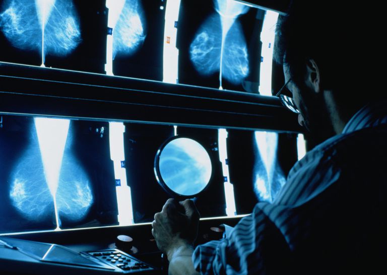 ¿Quién todavía recibe mamogramas después de la cirugía de mama?