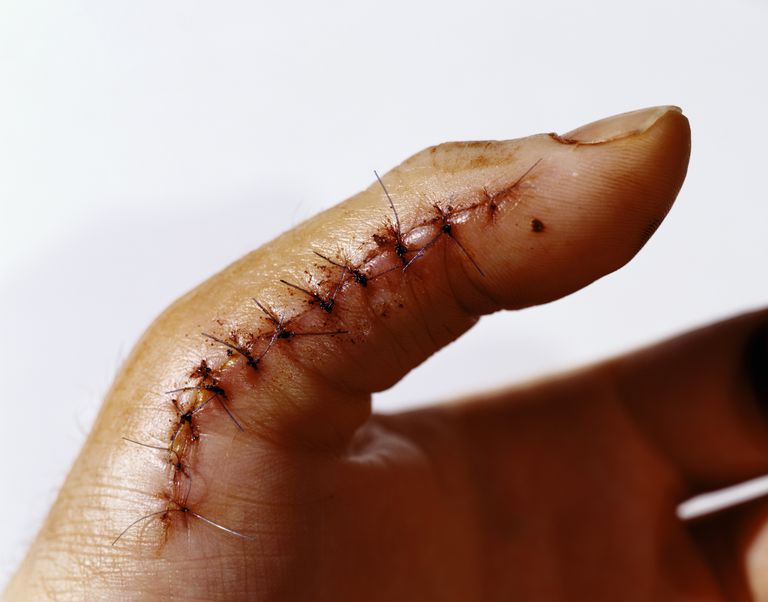 Por qué se usan las suturas para las lesiones